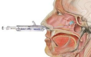 sphenopalatine ganglion block