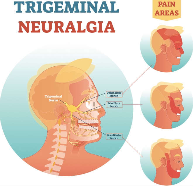 gabapentin trigeminal neuralgia reddit