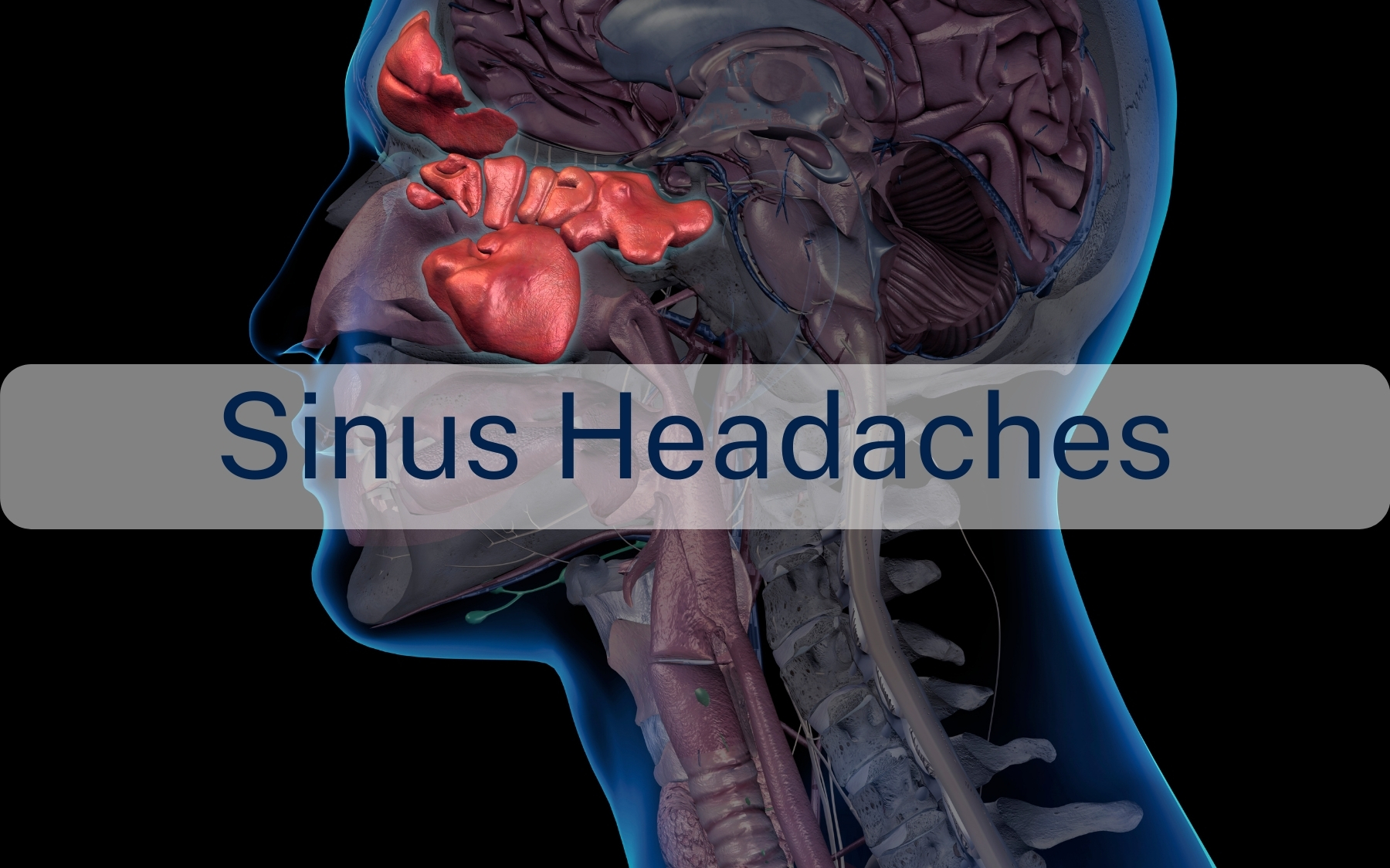 Sinus headaches